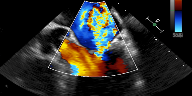 TOE (TransOesophageal Echocardiogram) – Heartwest